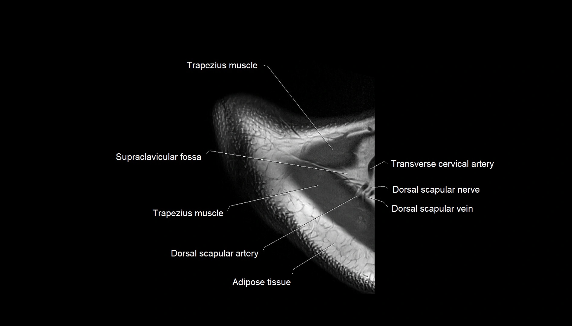 Shoulder cross sectional anatomy MRI 3T axial image 1.webp